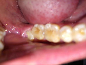 那个牙龈肿痛会影响响多吗,牙齿疼痛的危害